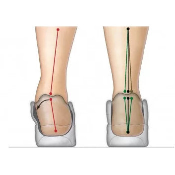Was versteht man unter einer Überpronation des Fußes?