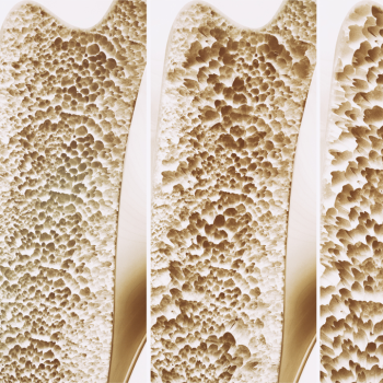 Was ist Osteoporose: Symptome, Risikofaktoren und Präventionsmethoden