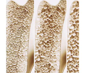Was ist Osteoporose: Symptome, Risikofaktoren und Präventionsmethoden