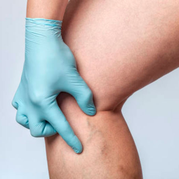 Phlebitis: Was ist das, Ursachen und Behandlung
