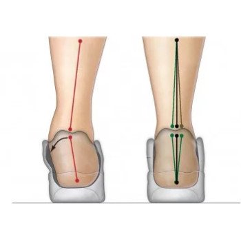 Was versteht man unter einer Überpronation des Fußes?