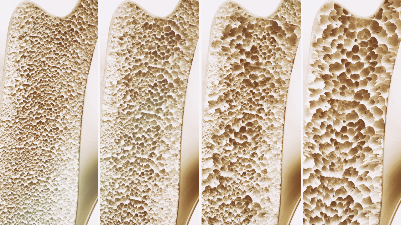 Was ist Osteoporose: Symptome, Risikofaktoren und Präventionsmethoden - Ortek